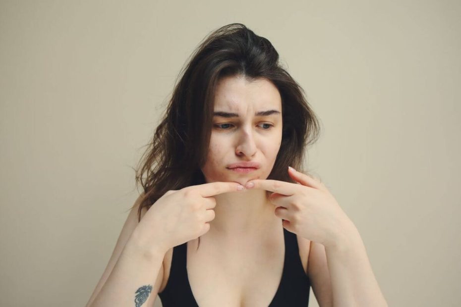 aliments à éviter acné hormonale