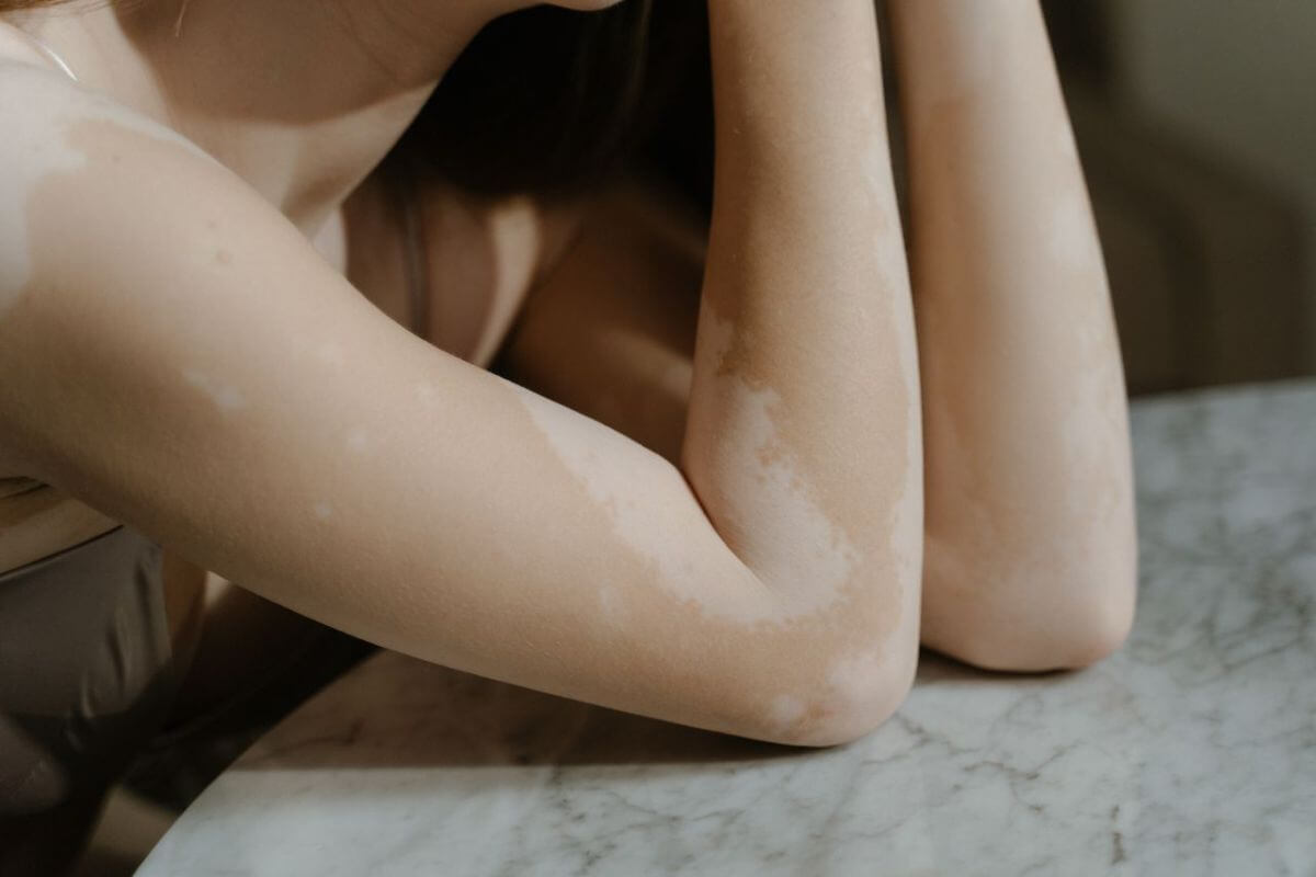 vitiligo aliments éviter